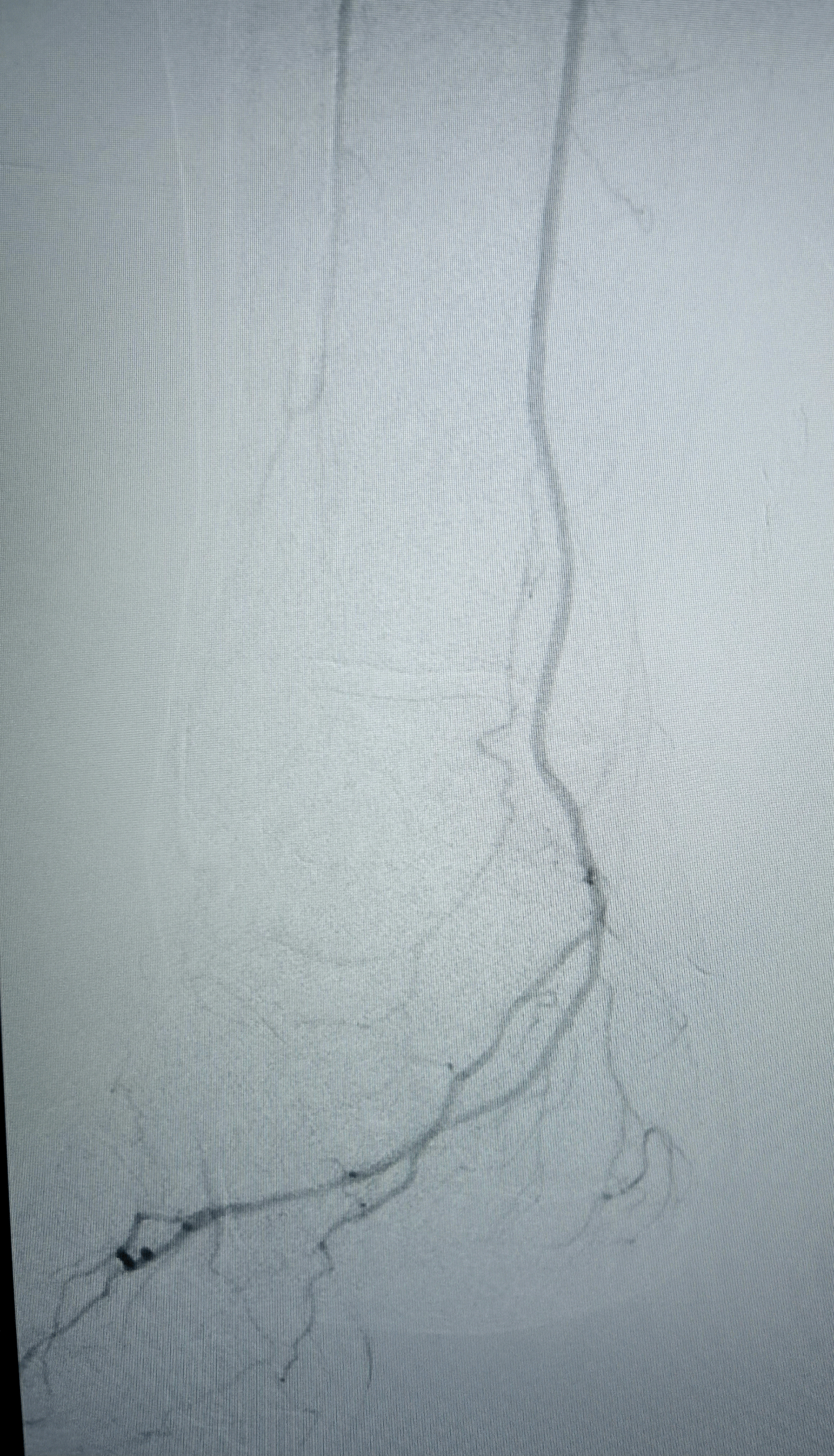 Cas 1 – Angio-TDM pré-opératoire