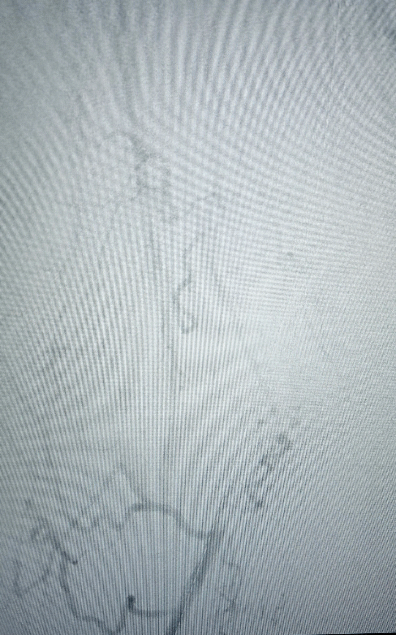 Cas 1 – Occlusion intra-stent