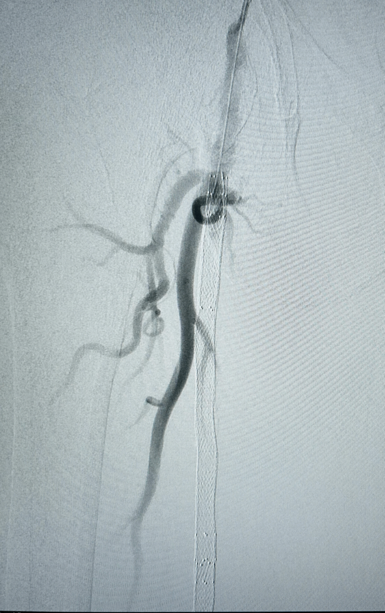 Cas 1 – Franchissement de l'occlusion