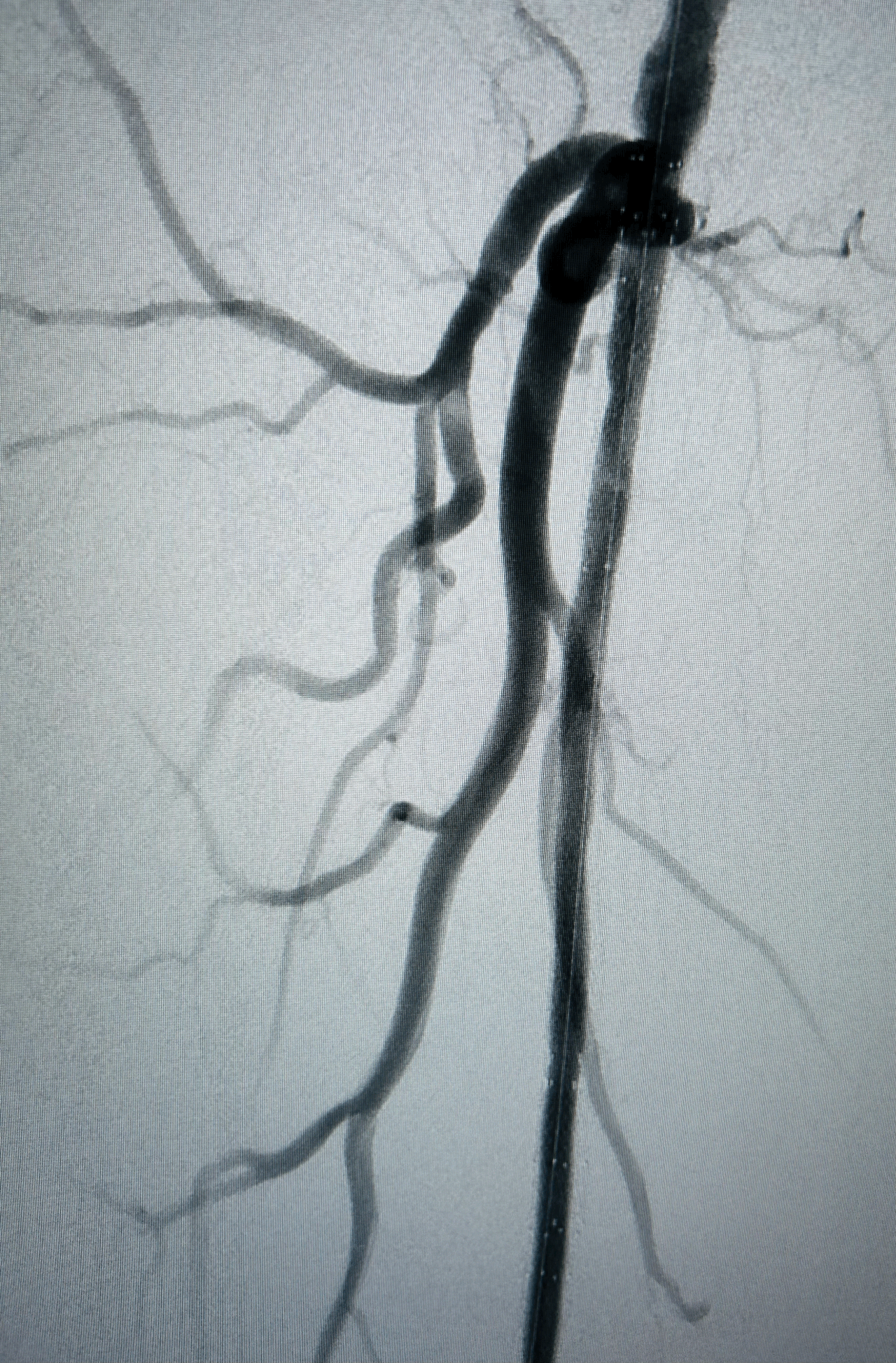 Cas 1 – Mise en place des endoprothèses
