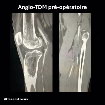 Cas 2 – Angio-TDM pré-opératoire