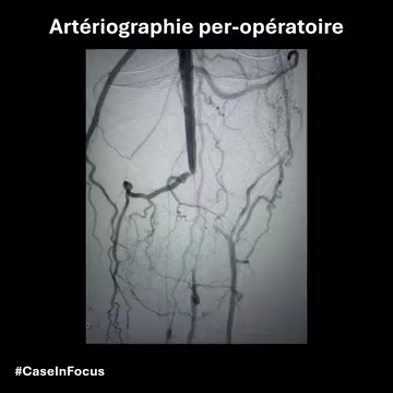 Cas 2 – Lésion poplitée