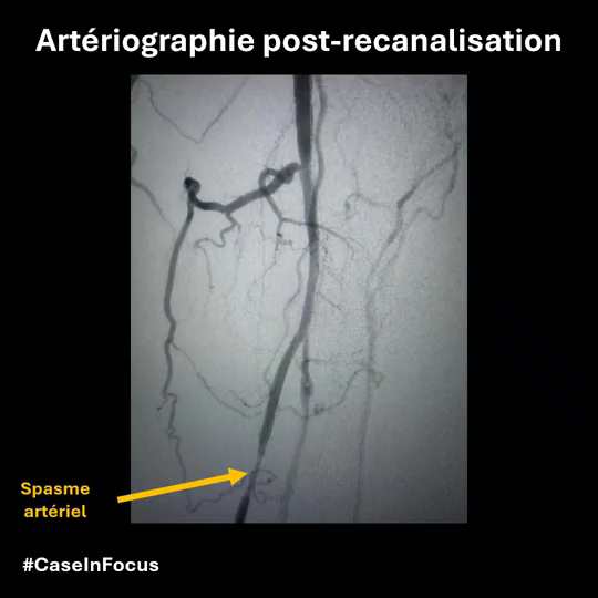 Cas 2 – Franchissement de l'occlusion