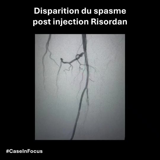 Cas 2 – Ballon actif LITOS