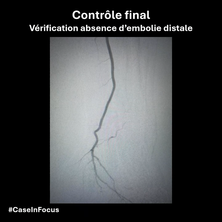 Cas 2 – Endoprothèse poplitée