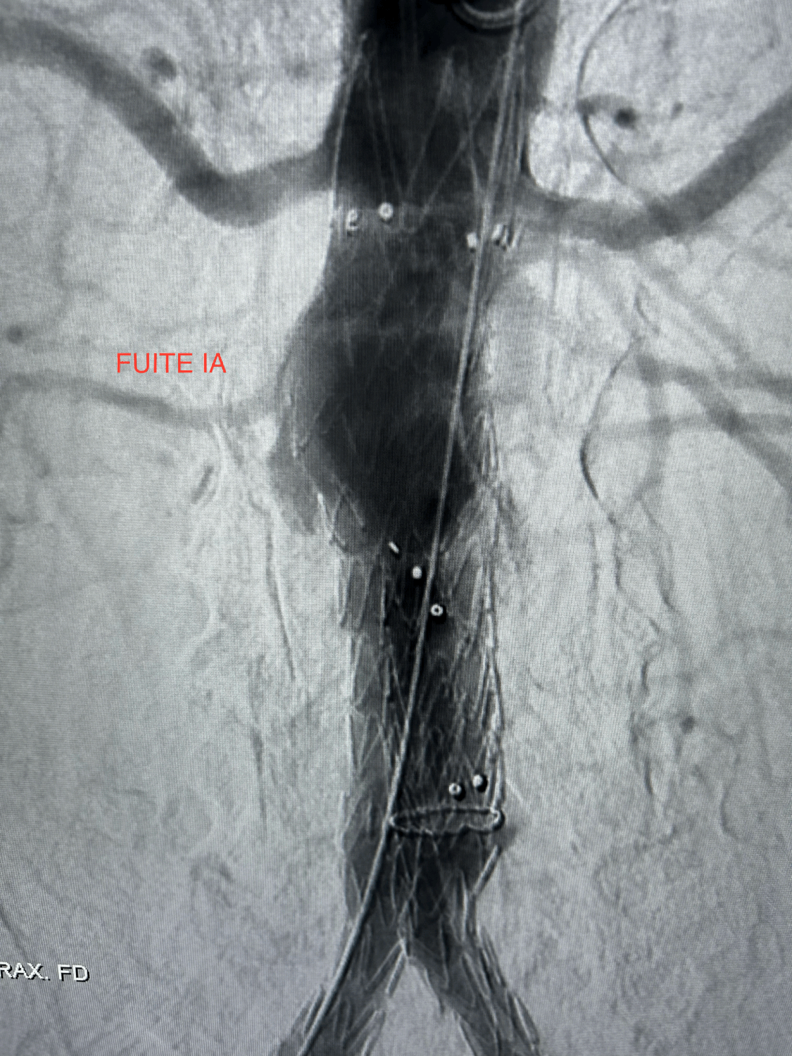 Cas 3 – Endofuite de type IA avant endofixation