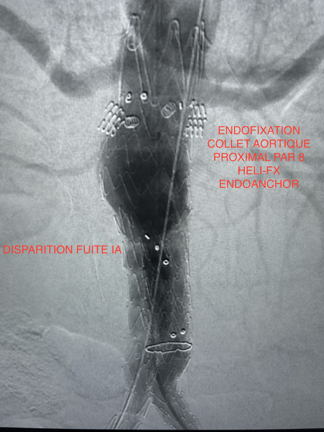 Cas 3 – Résultat après endofixation