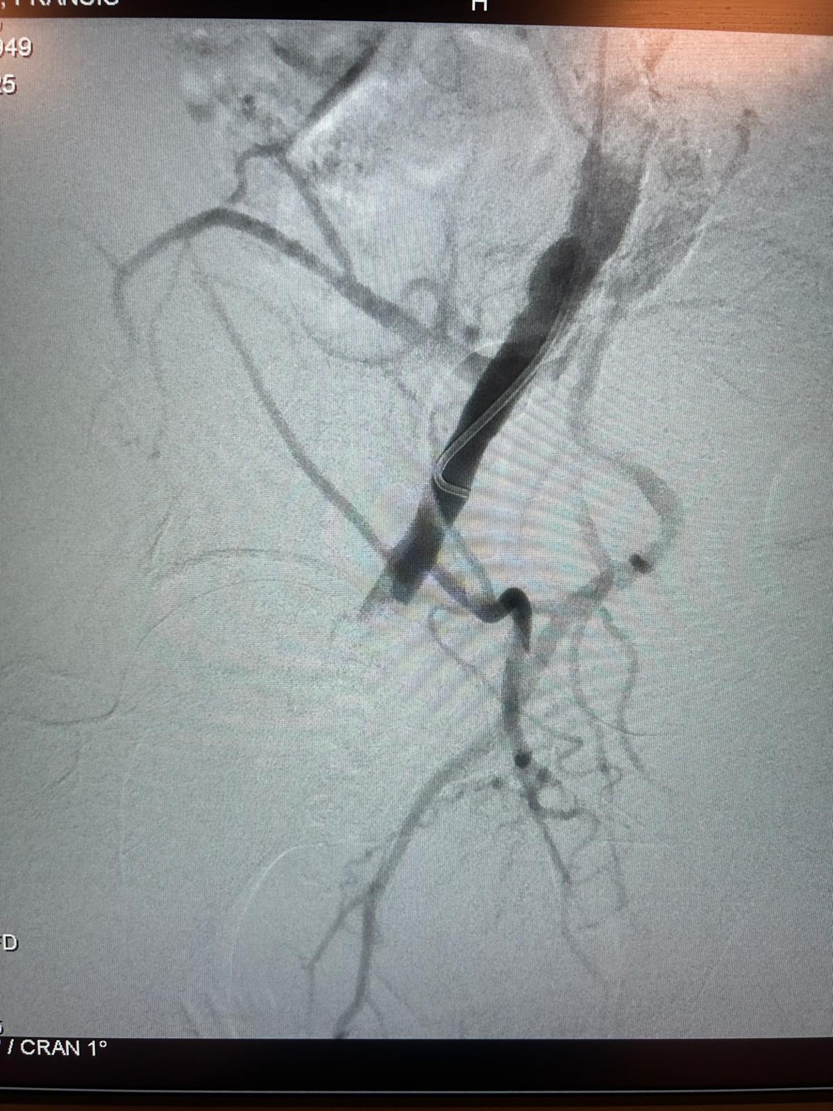 Athérectomie endovasculaire – Imagerie pré-opératoire