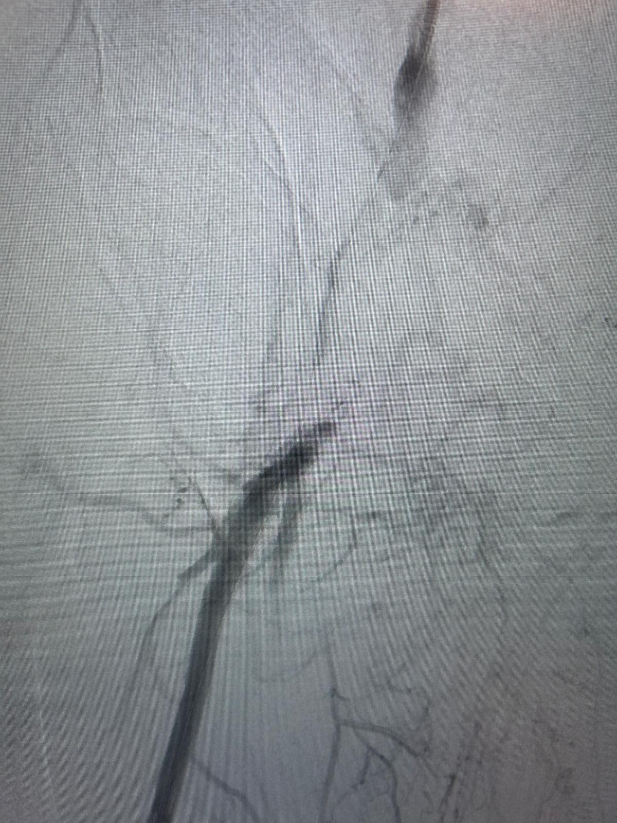 Athérectomie endovasculaire – Lésion artérielle ciblée
