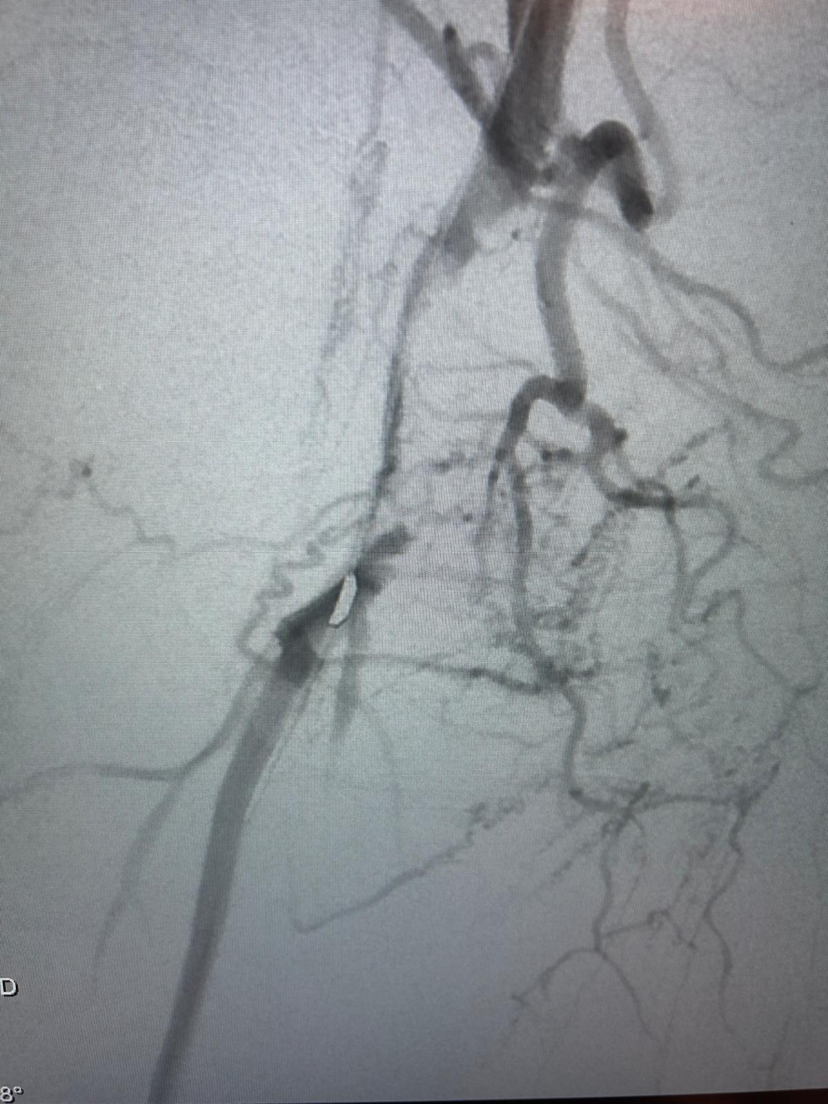 Athérectomie endovasculaire – Dispositif d’athérectomie
