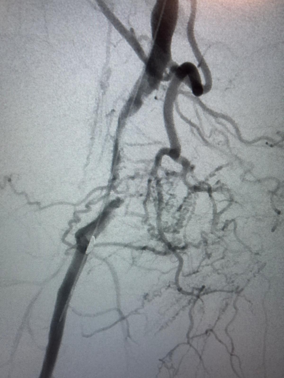 Athérectomie endovasculaire – Retrait de plaque d’athérome