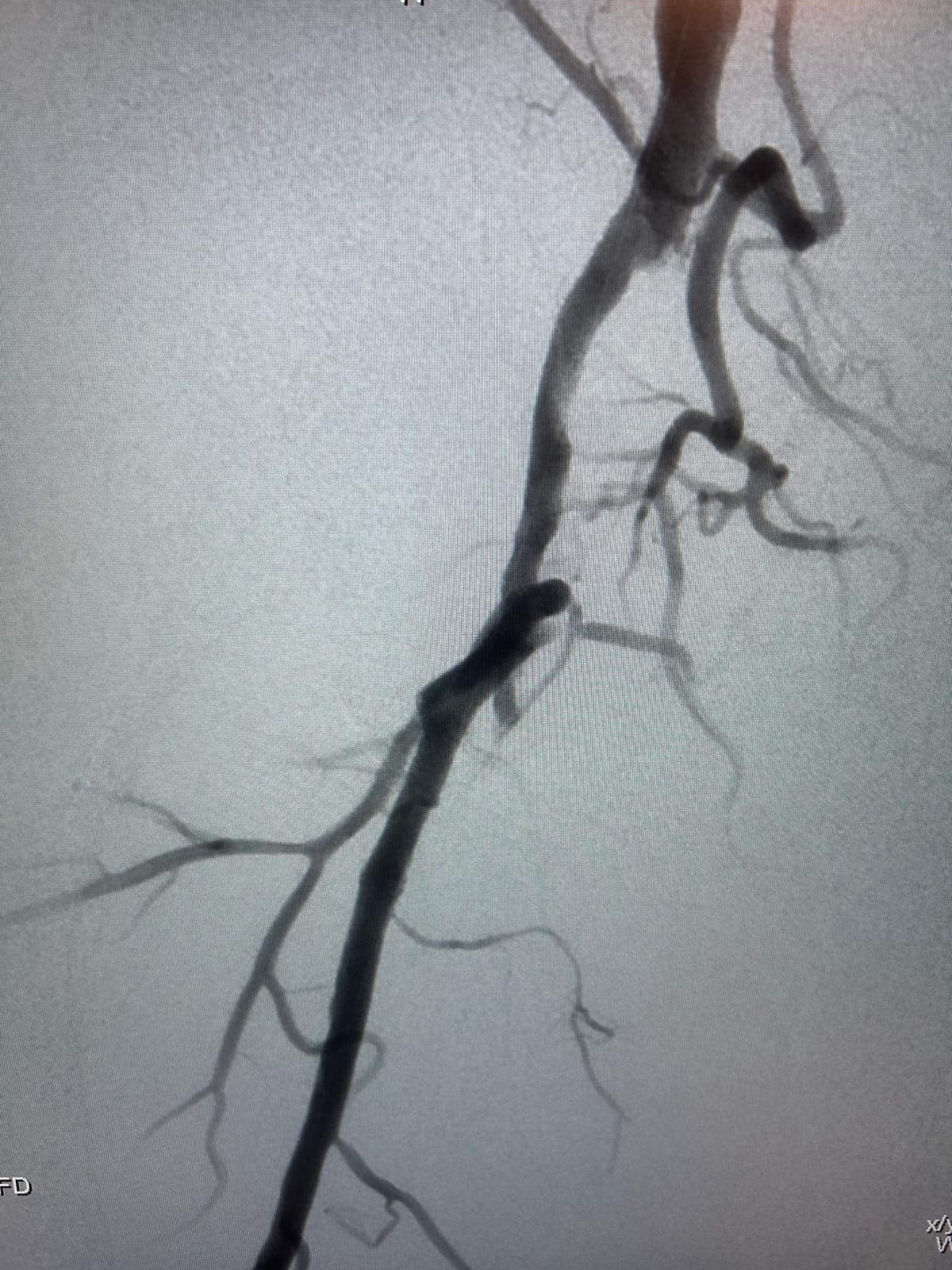 Athérectomie endovasculaire – Angioplastie complémentaire