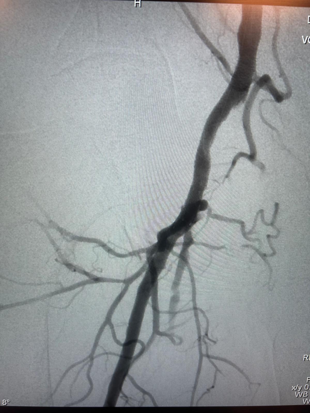 Athérectomie endovasculaire – Résultat final