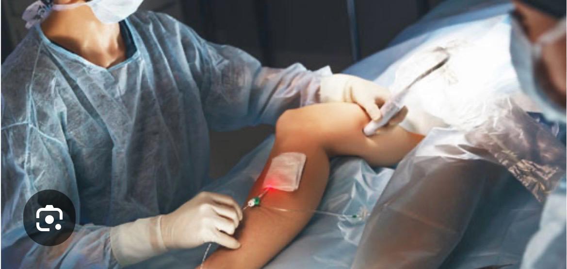 Traitement endoveineux des varices – Occlusion endothermique de la veine saphène