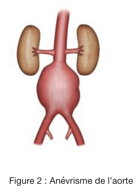 Imagerie médicale d'un anévrisme