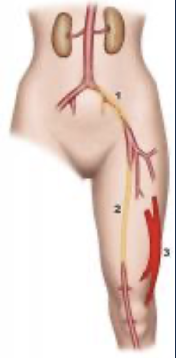 Réduction du flux artériel