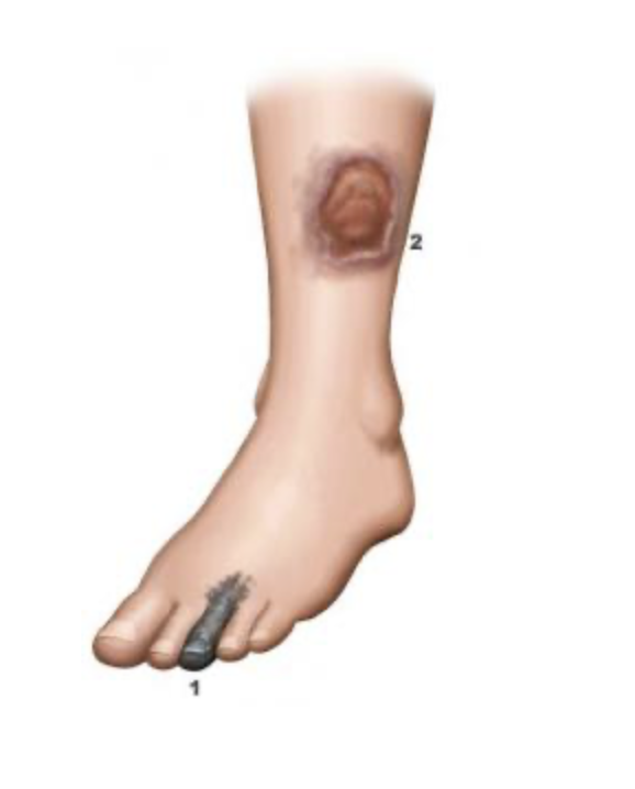 Imagerie de l'artérite des membres inférieurs