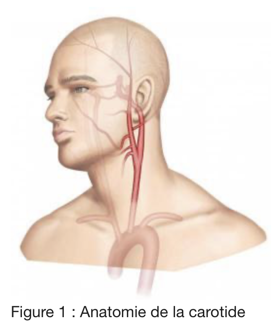 Sténose carotidienne