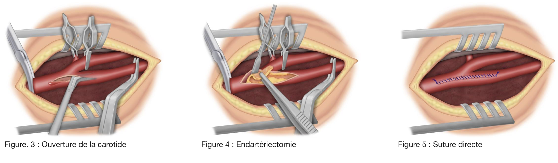 Traitement chirurgical de la sténose
