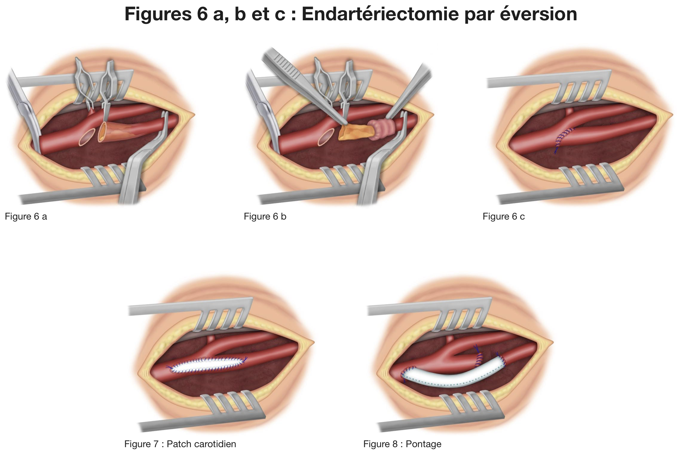 Technique chirurgicale