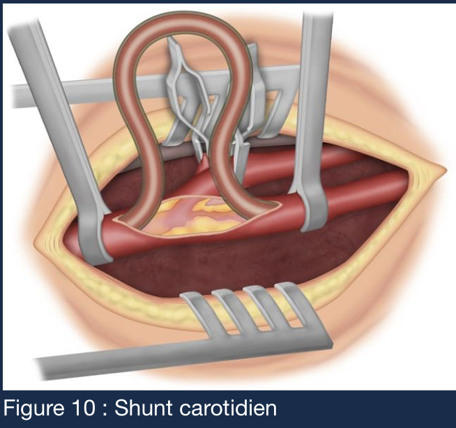 Protection cérébrale et shunt carotidien