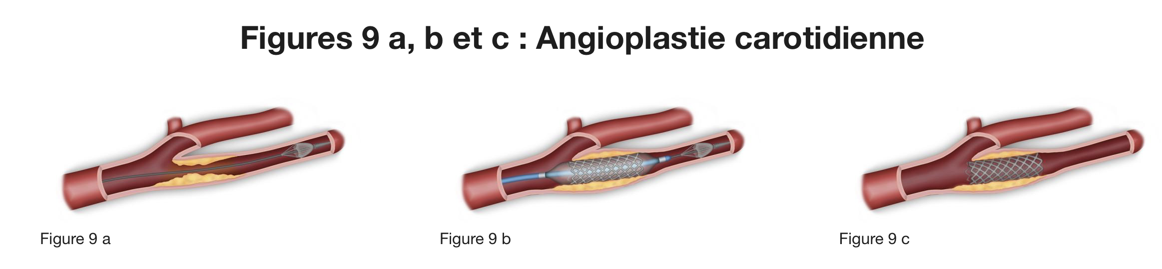 Angioplastie carotidienne avec stent